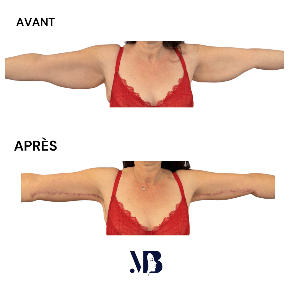 La brachioplastie permet de retirer par la chirurgie plastique l'excès de peau et de graisse du membre supérieur.