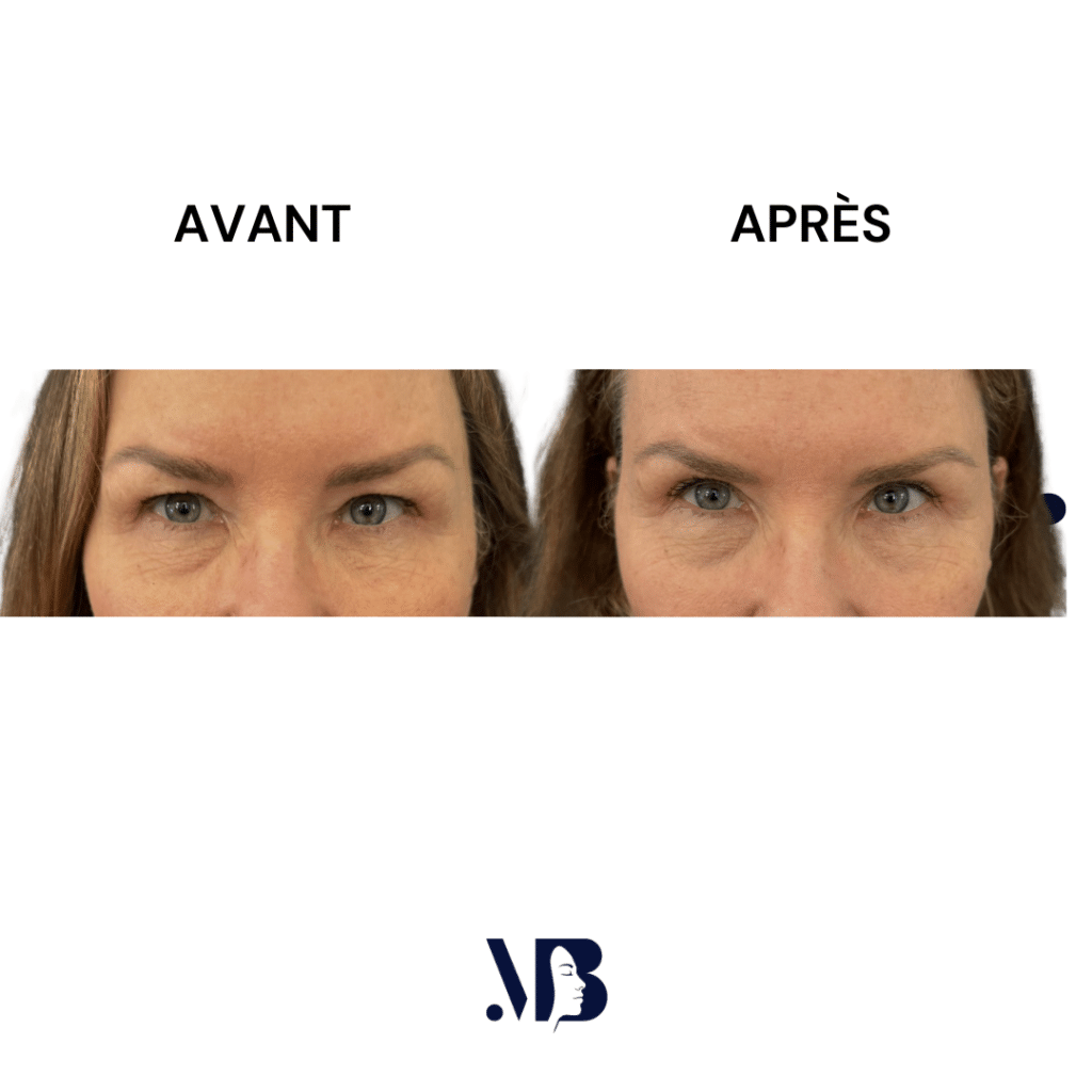 La blépharoplastie supérieure est la chirurgie esthétique des paupières tombante.