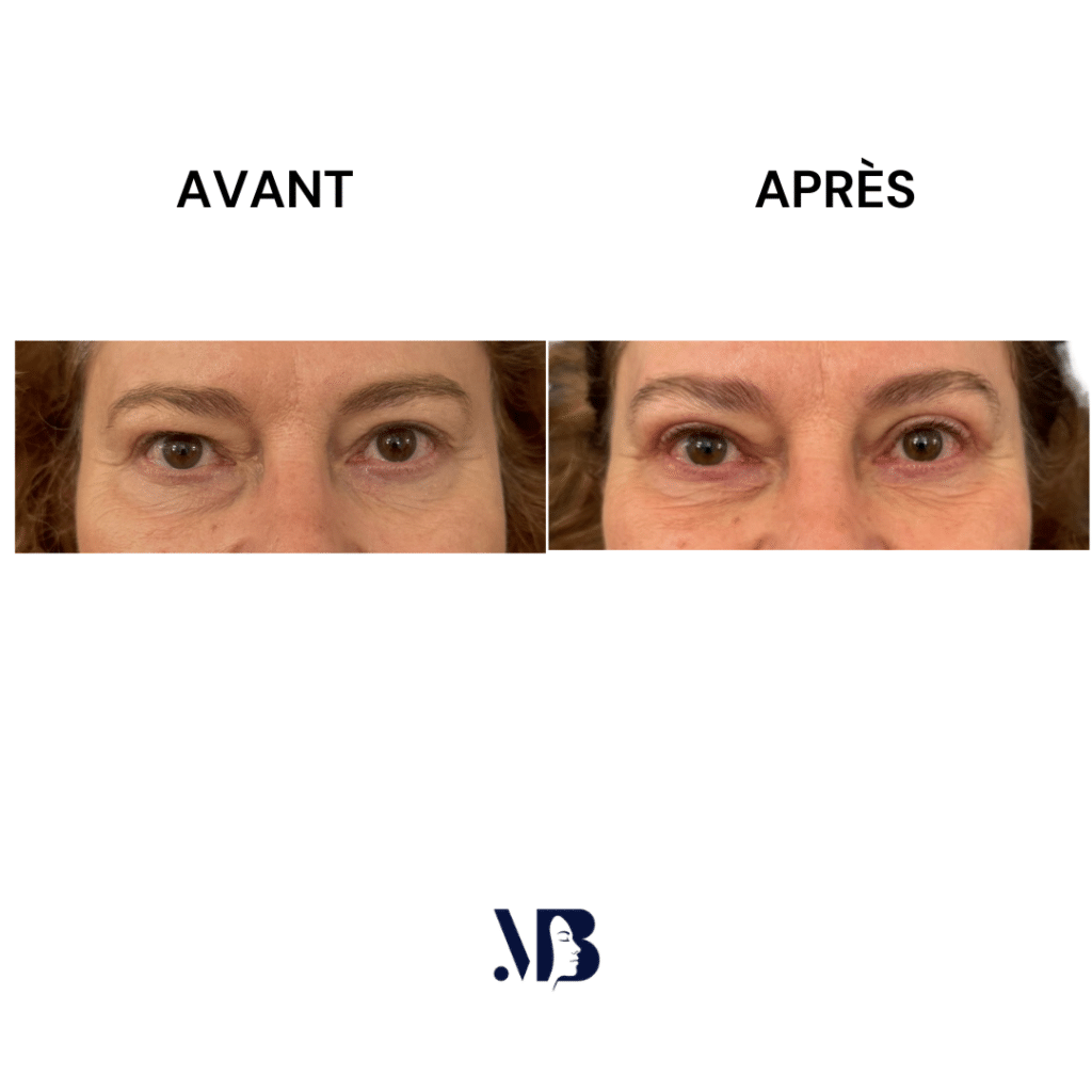La blépharoplastie supérieure est la chirurgie esthétique des paupières tombante.