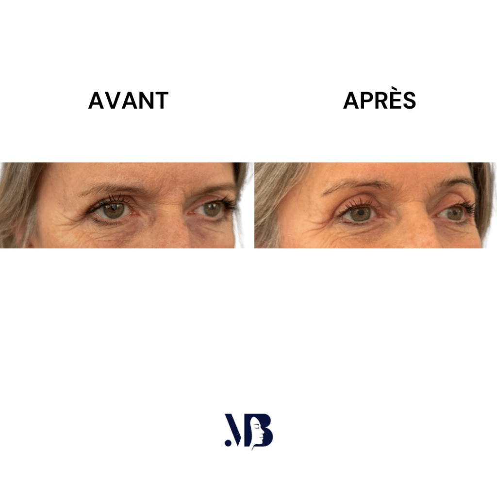 La blépharoplastie supérieure est la chirurgie esthétique des paupières tombante.