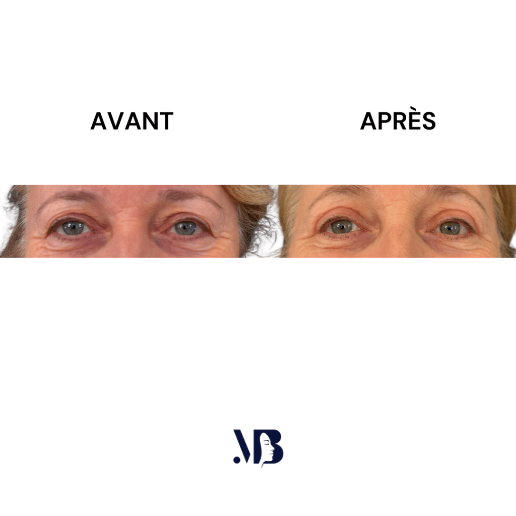 La blépharoplastie supérieure est la chirurgie esthétique des paupières tombante.