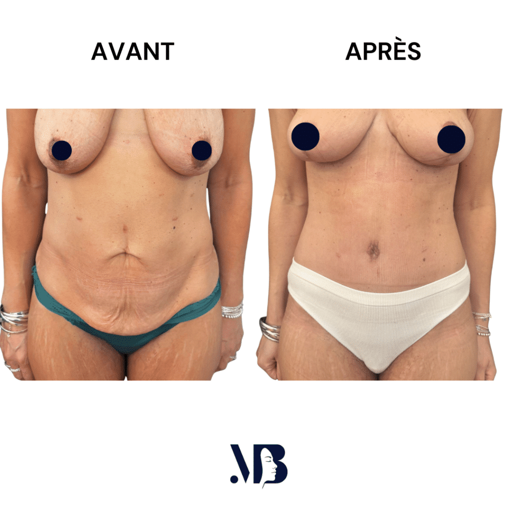 L'abdominoplastie ou plastie abdominal est un lifting du ventre qui permet de diminuer le volume de celui-ci.