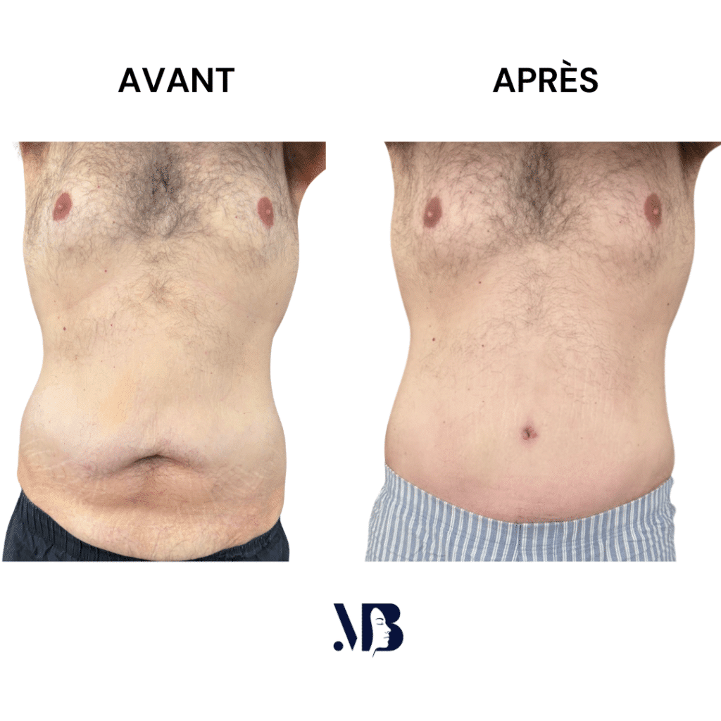 L'abdominoplastie ou plastie abdominal est un lifting du ventre qui permet de diminuer le volume de celui-ci.